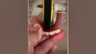 Partial Flexible Invisible Denture For Anterior Teeth #dentaltechnician #dentallaboratory #dentist