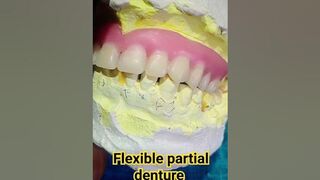 flexible partial denture by Ali dental ceramic and ideas #partialdenture #completedenture