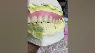 Upper Flexible Partial Denture By Haider #dentures #rpd #dentalartbyhaider