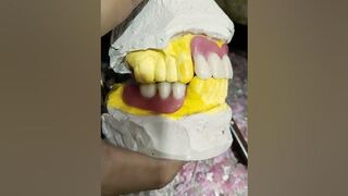 Flexible Partial Denture Ready For Try In ????????????