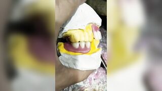 Flexible Partial Denture Ready For Try In ????????????