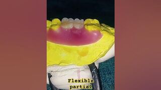 flexible partial denture ready for flask by Ali dental ceramic #removabledenture #completedenture