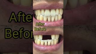 Missing teeth || Flexible Partial Denture || #missingteeth #flexibledenture