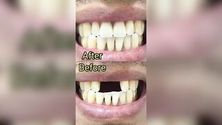 Missing teeth || Flexible Partial Denture || #missingteeth #flexibledenture