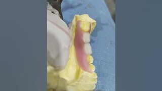 2 unit Flexible Partial Denture By Haider ????????????#dentalwork #rpddentalprocedure #dentures