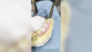 2 unit Flexible Partial Denture By Haider ????????????#dentalwork #rpddentalprocedure #dentures