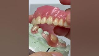 Flexible partial and denture for one patient!