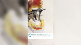 Initial stages of FLEXIBLE DENTURES #dentistryworld #dental #shortvideo #dentistry