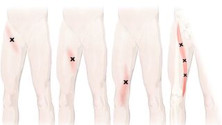 causes of sartorius muscle injury,anatomy, origin, insertion, action , release, stretching, release