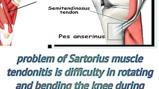 causes of sartorius muscle injury,anatomy, origin, insertion, action , release, stretching, release