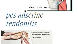 causes of sartorius muscle injury,anatomy, origin, insertion, action , release, stretching, release